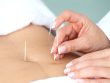Læge-påføring-akupunktur-på-maven